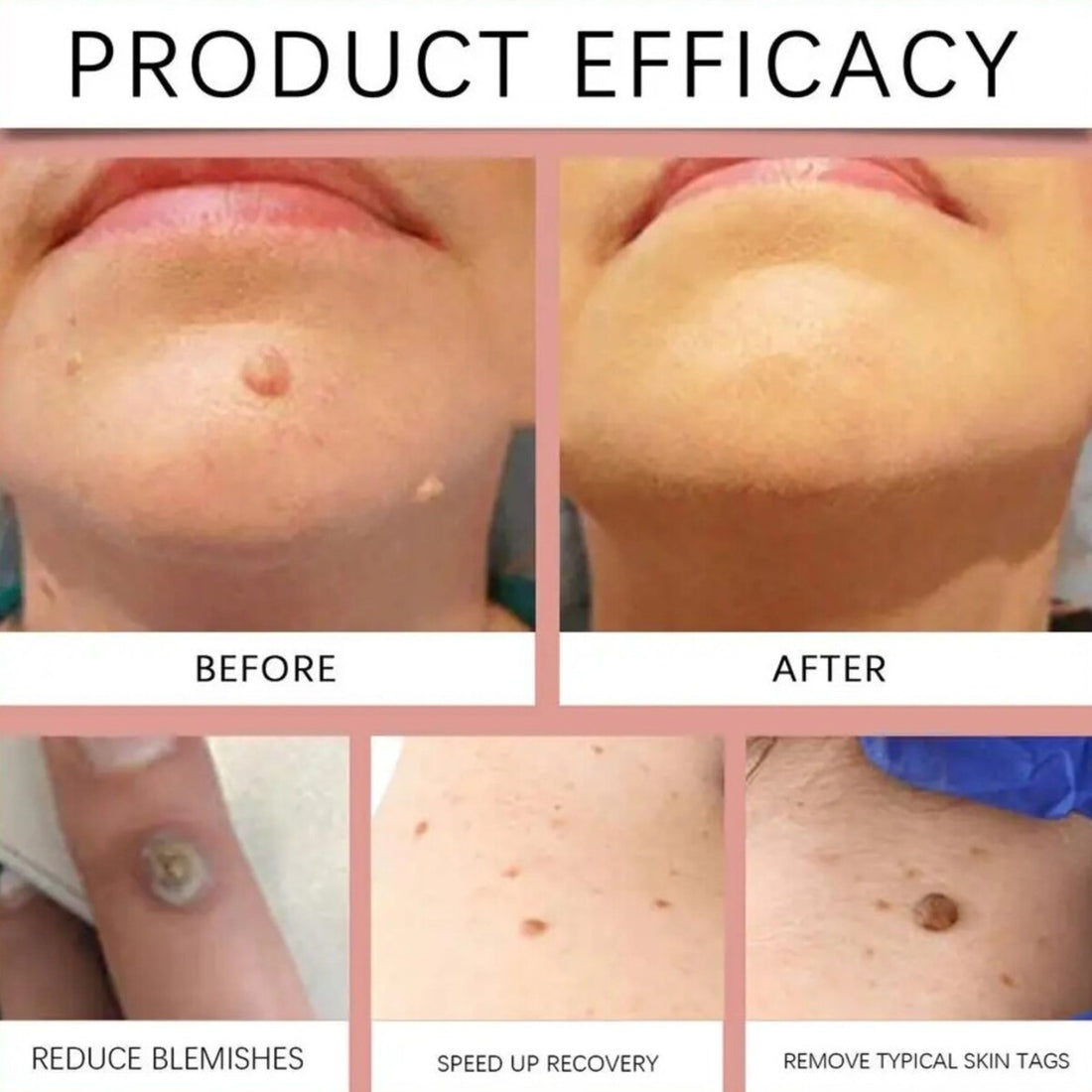 Painless Micro-Patch For Skin Tag, Mole & Wart Removal 12026003226942-1