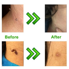 Complete Skin Tag Removal Treatment Kit (50 pcs rubber band kit)