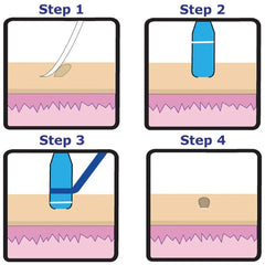 Complete Skin Tag Removal Treatment Kit (50 pcs rubber band kit)