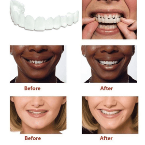 Magic Teeth Snap On Veneers