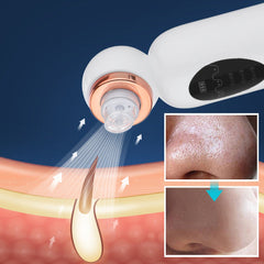 Hydrodermabrasion Blackhead Remover
