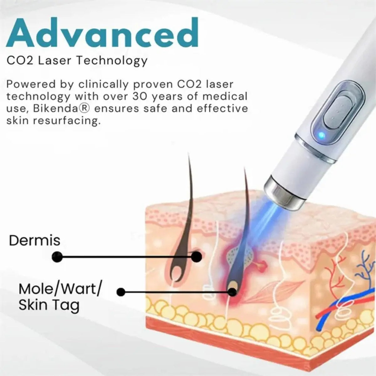 2 Pcs of Non-Invasive Mole and Wart Removal Laser Pen 15230708613507-1