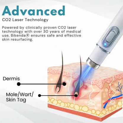 2 Pcs of Non-Invasive Mole and Wart Removal Laser Pen 15230708613507-1