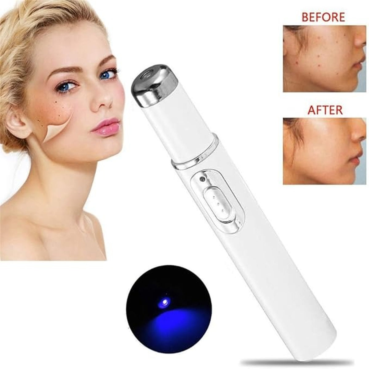 2 Pcs of Non-Invasive Mole and Wart Removal Laser Pen 15230708613507-1