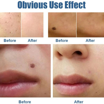 Mole And Dark Spot Electric Pen Remover 8746281369934-1