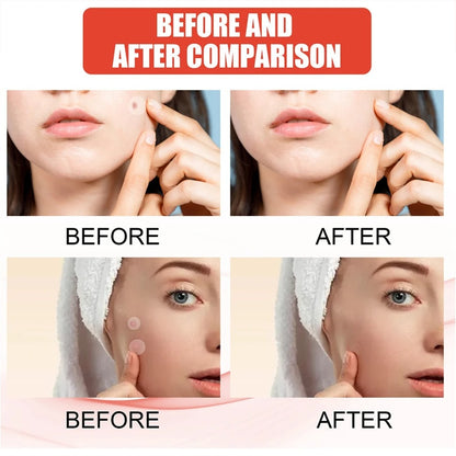 Painless Micro-Patch For Skin Tag, Mole & Wart Removal 12026003226942-1