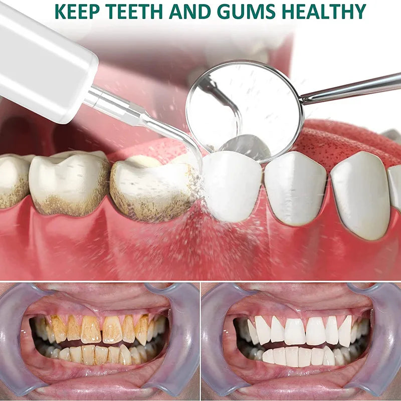 Easy Home Ultrasonic Calculus Remover Dental Scaler 8142383448264-al