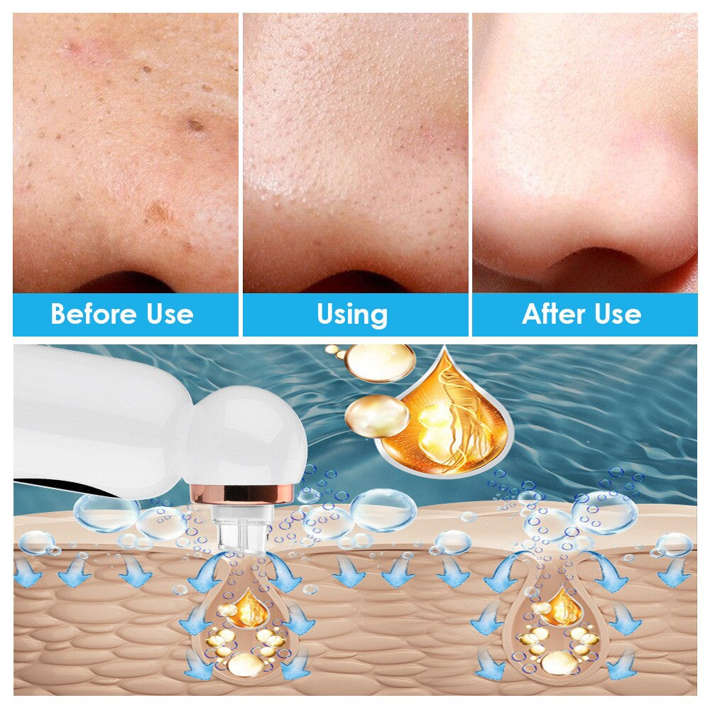 Hydrodermabrasion Blackhead Remover