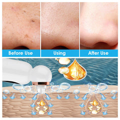 Hydrodermabrasion Blackhead Remover