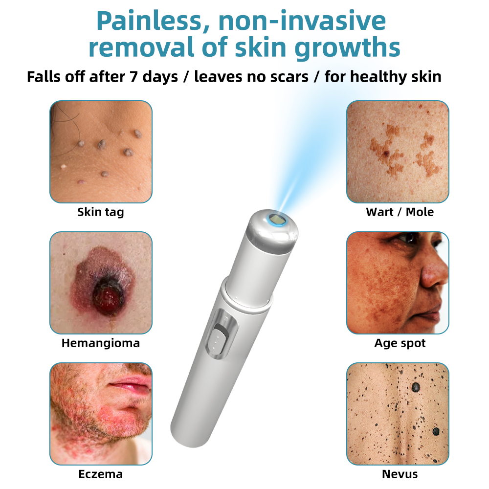 2 Pcs of Non-Invasive Mole and Wart Removal Laser Pen 15230708613507-1