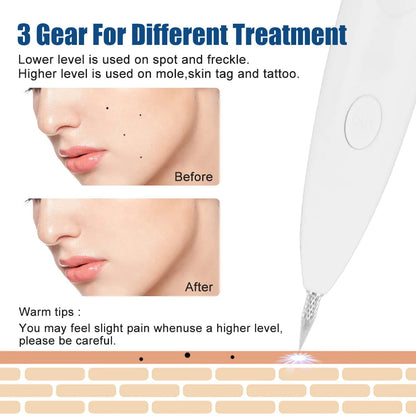 Mole And Dark Spot Electric Pen Remover 8746281369934-1