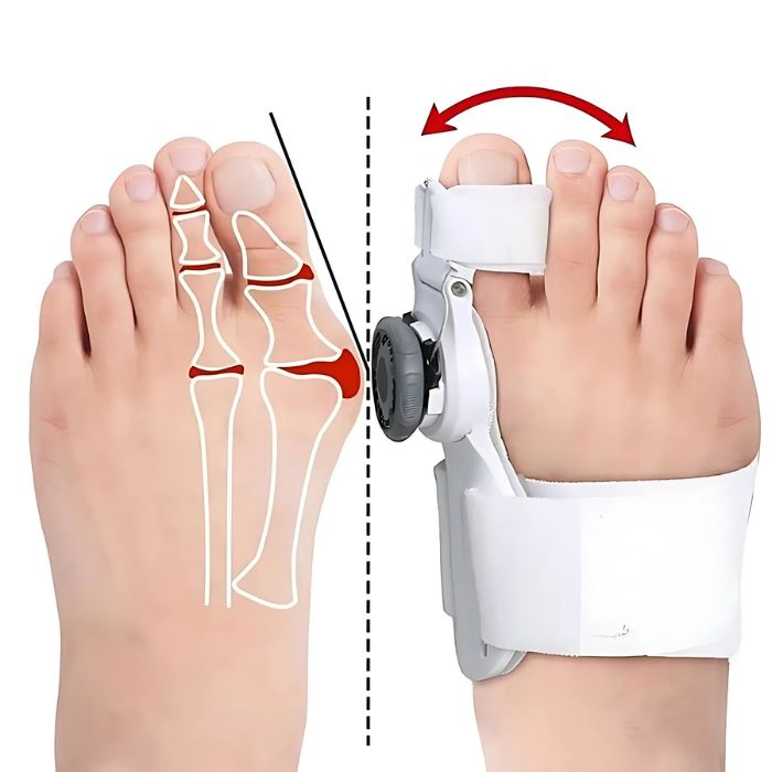 1 Pcs Upgraded Toe Bunion Corrector