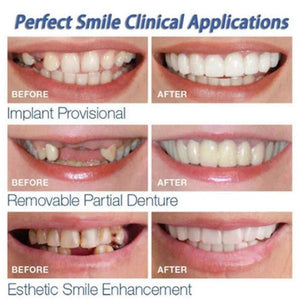 Veneers (Top &Amp; Bottom)