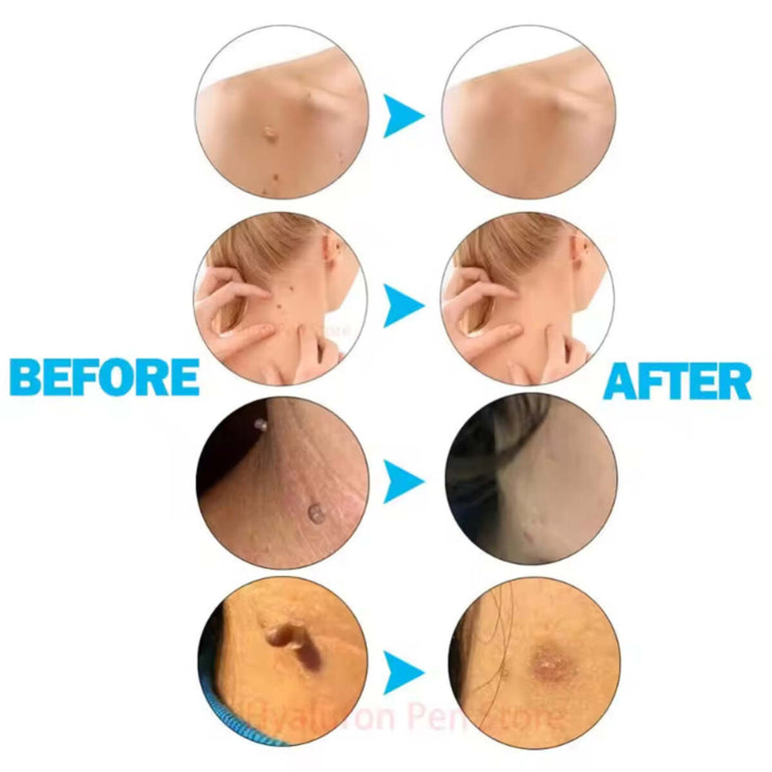 Painless Small Skin Tag Removal – Fast, Safe & Easy at Home 253958