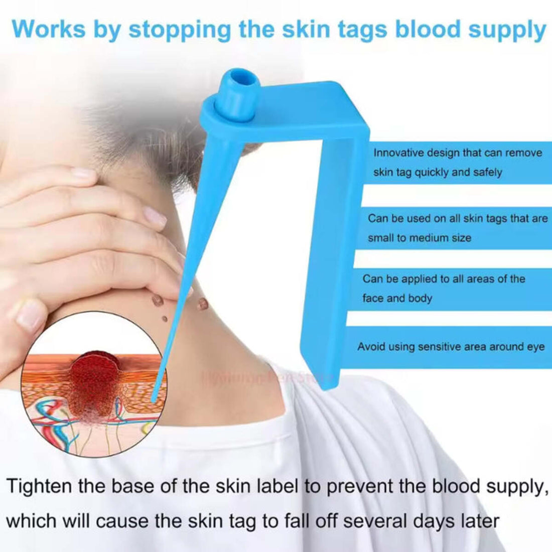 Painless Small Skin Tag Removal – Fast, Safe & Easy at Home 253958