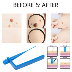 Complete Skin Tag Removal Treatment Kit (50 pcs rubber band kit)