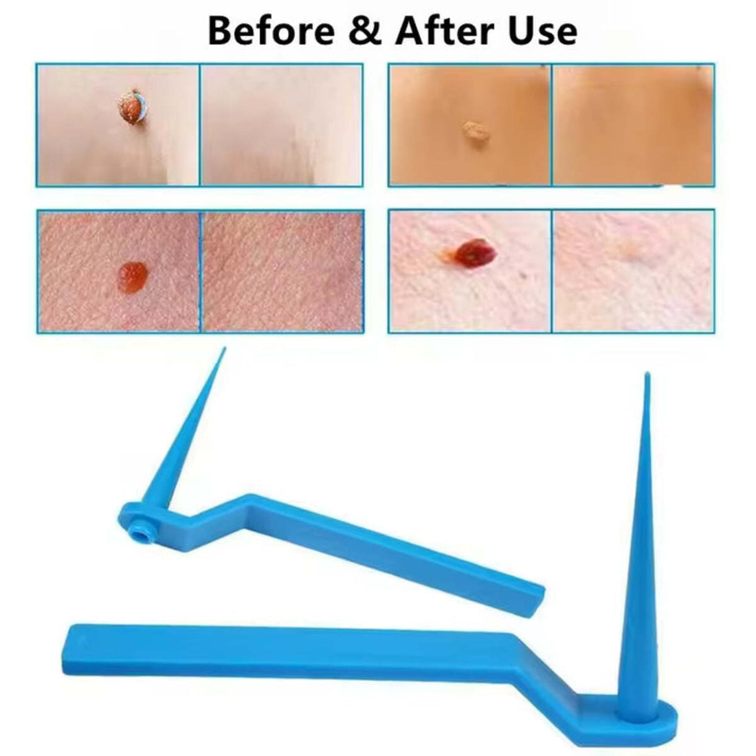 Painless Small Skin Tag Removal – Fast, Safe & Easy at Home 253958