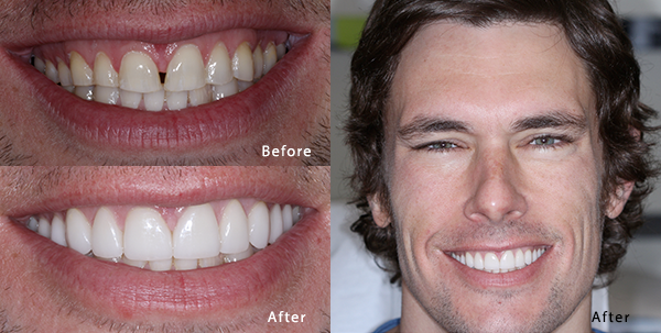 Veneers (Top &Amp; Bottom)