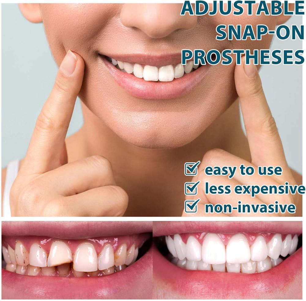Adjustable Snap-On Denture Fit Kit