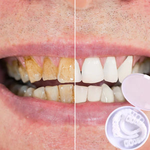 Snap-On Teeth - Always The Perfect Smile With These Veneers