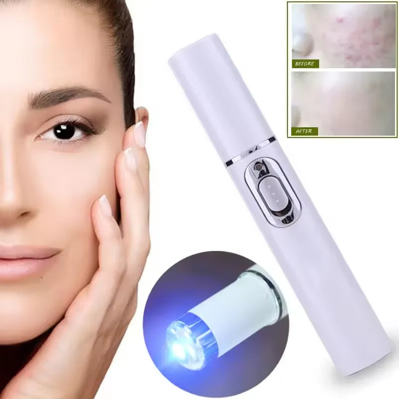 Spider Veins Removal Pen