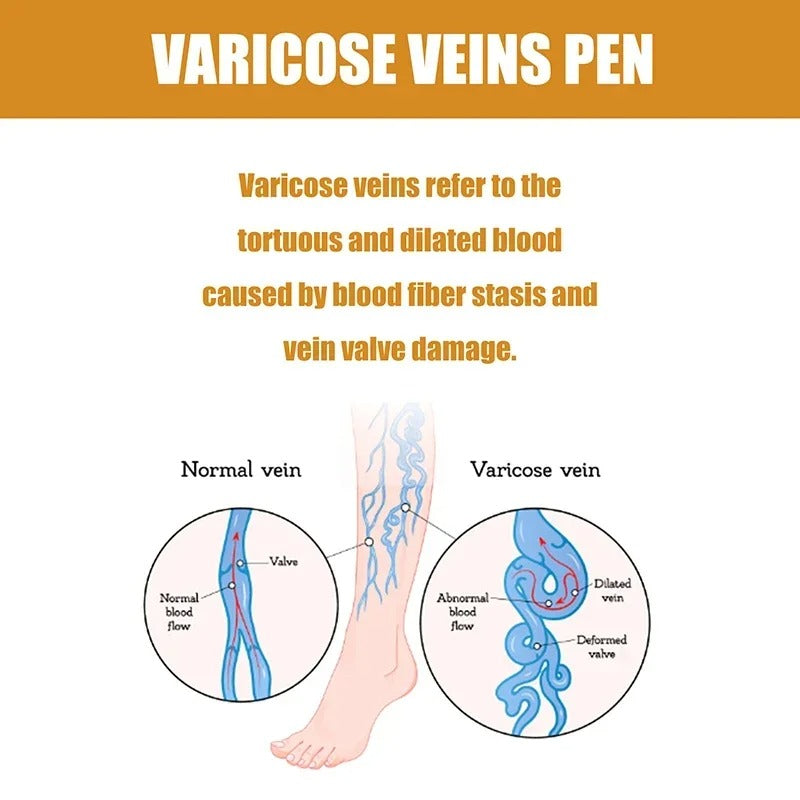 Set of 2 Varicose Spider Veins Removal Pens 250868