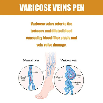 Set of 2 Varicose Spider Veins Removal Pens 250868