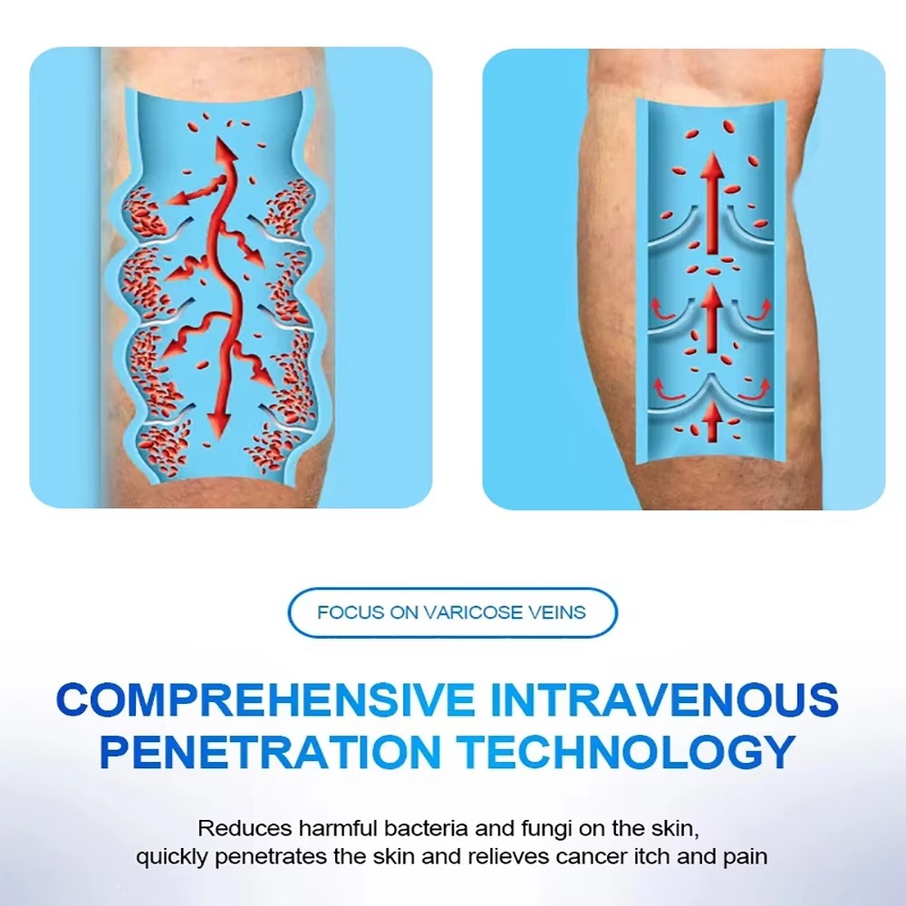 Varicose Spider Veins Removal Pen 4