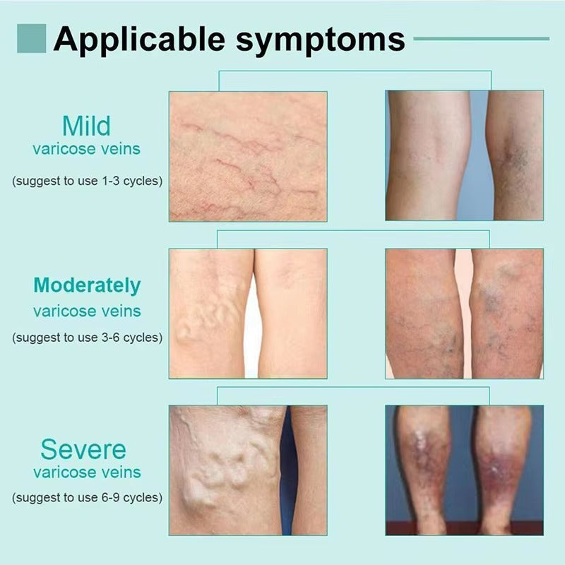 Set of 2 Varicose Spider Veins Removal Pens 250868