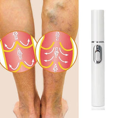 Varicose Spider Veins Removal Pen 6