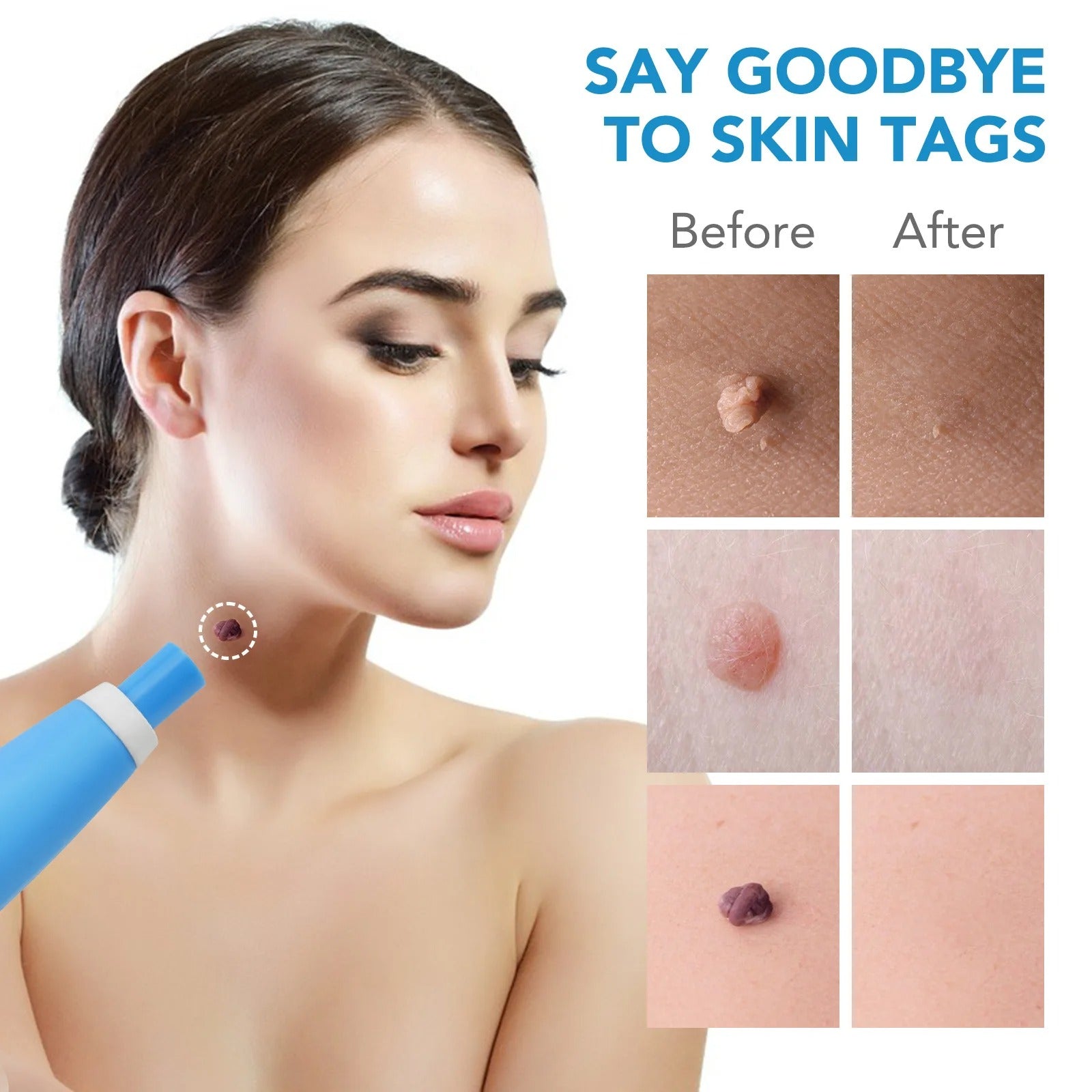 2-In-1 Skin Tag And Mole Remover Kit 339068