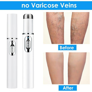 Bluelight Therapy Pen For Varicose Veins