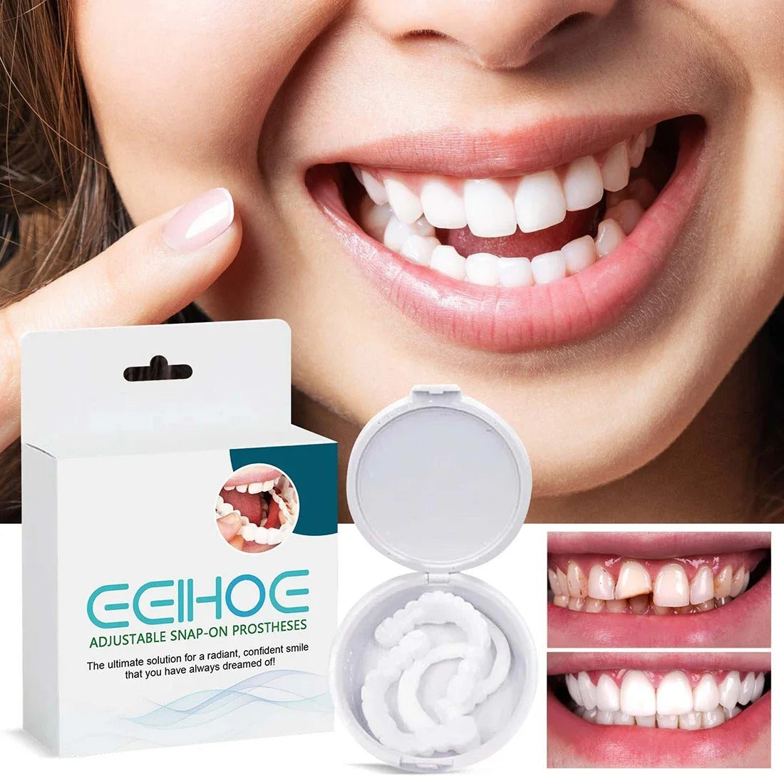 Temporary Custom Mold for Stained or Missing Teeth 252138