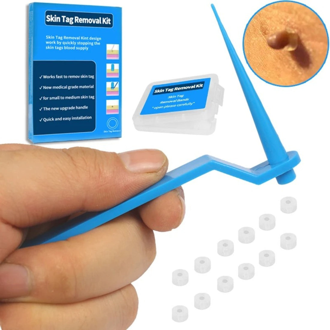 Painless Small Skin Tag Removal – Fast, Safe & Easy at Home 253958