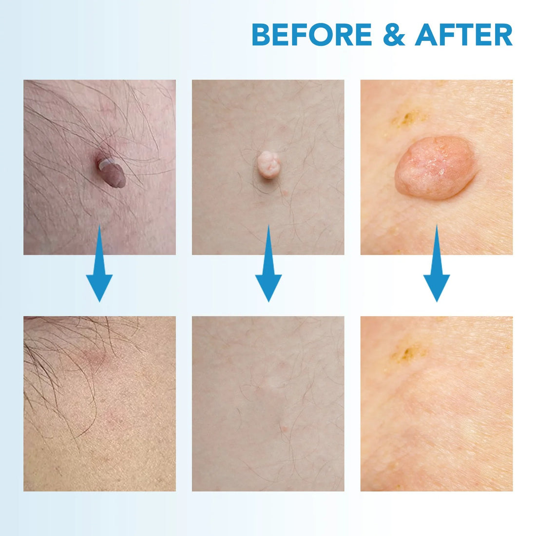 2-In-1 Skin Tag And Mole Remover Kit 339068