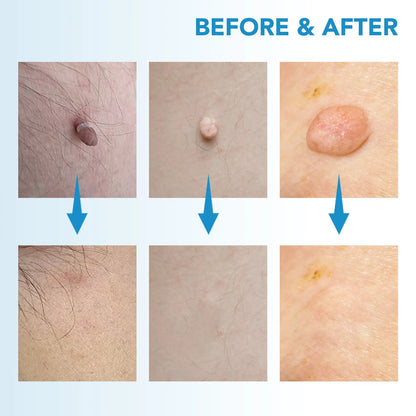 2-In-1 Skin Tag And Mole Remover Kit 339068