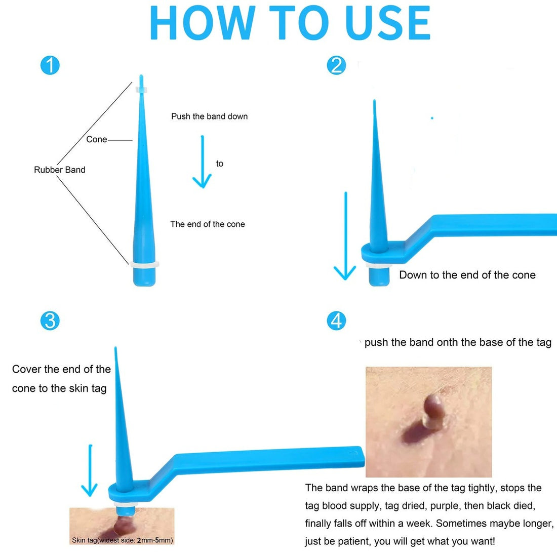 Painless Small Skin Tag Removal – Fast, Safe & Easy at Home 253958