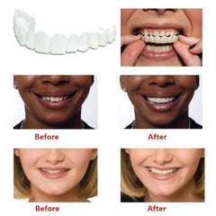 Temporary Custom Mold for Stained or Missing Teeth