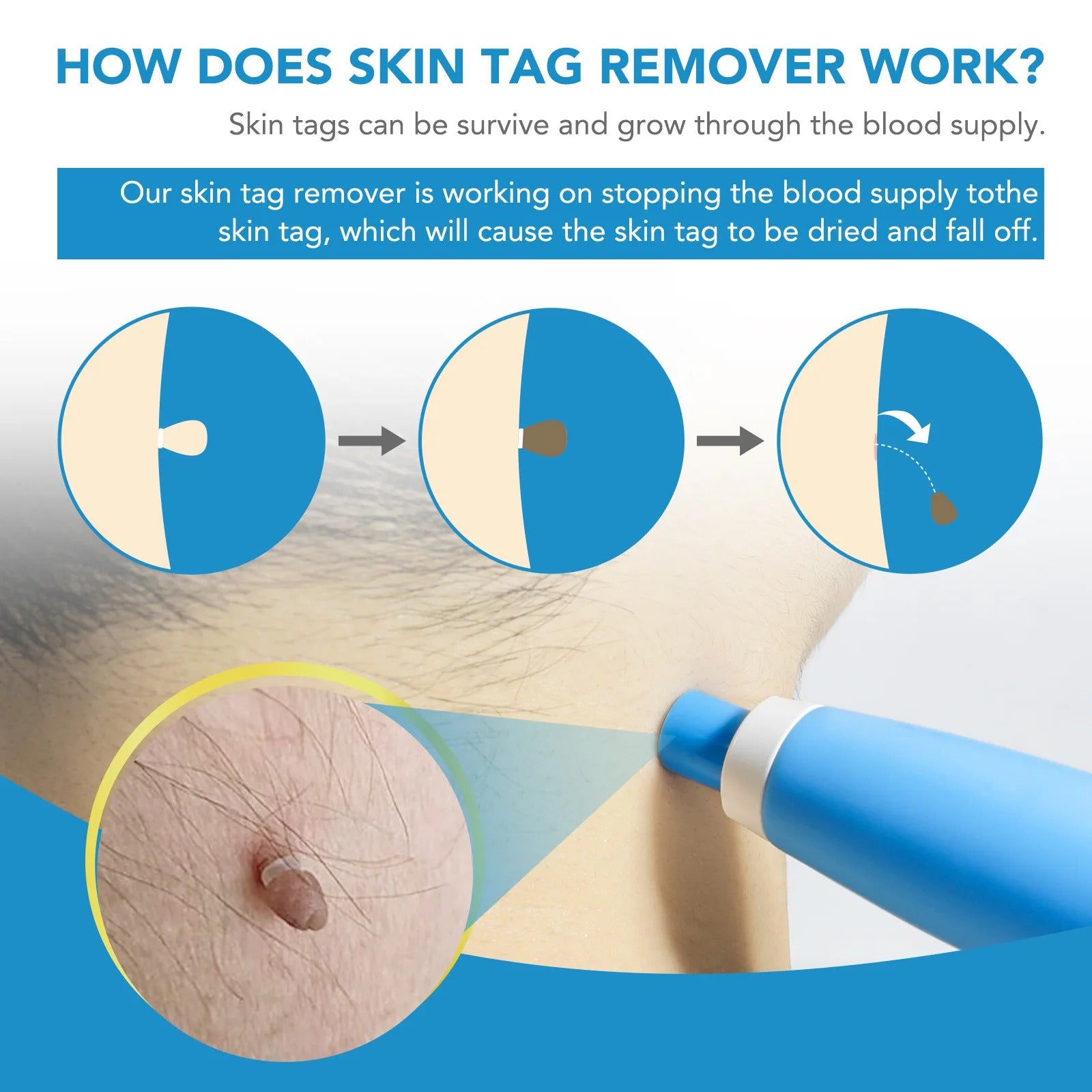 2-In-1 Skin Tag And Mole Remover Kit 339068