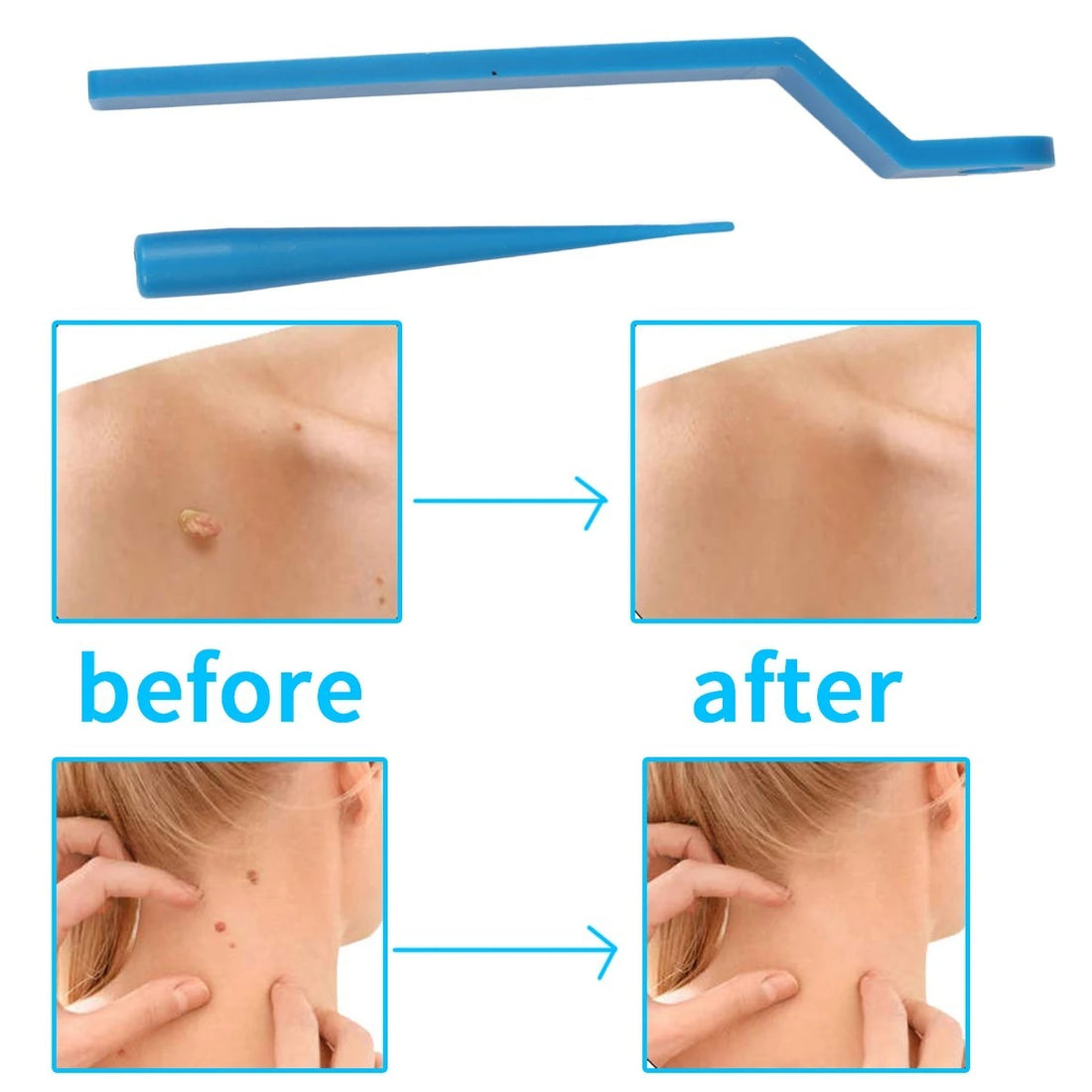 Painless Small Skin Tag Removal – Fast, Safe & Easy at Home 253958