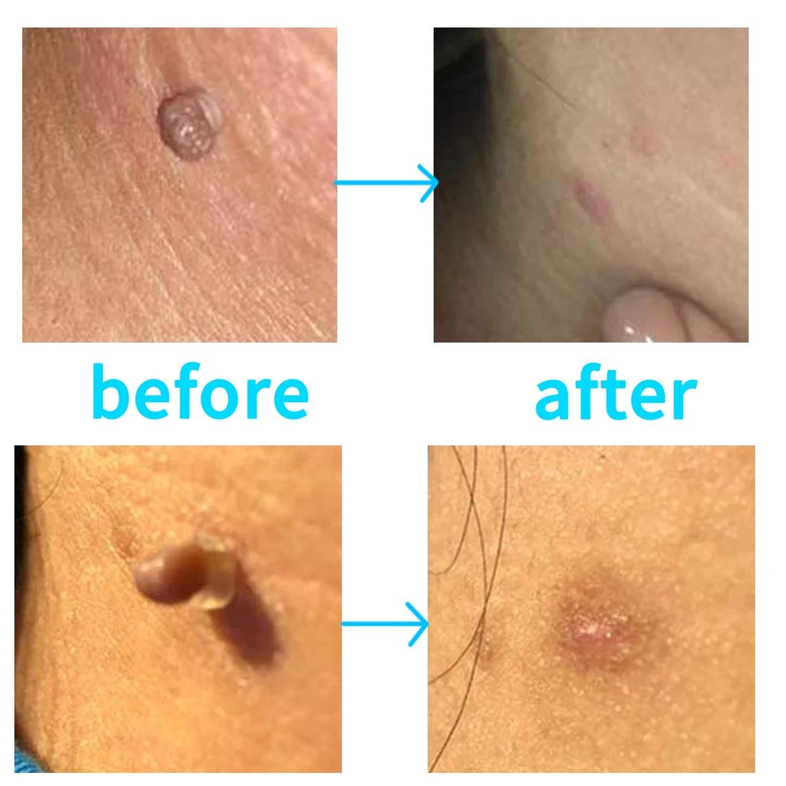 Painless Small Skin Tag Removal – Fast, Safe & Easy at Home 253958