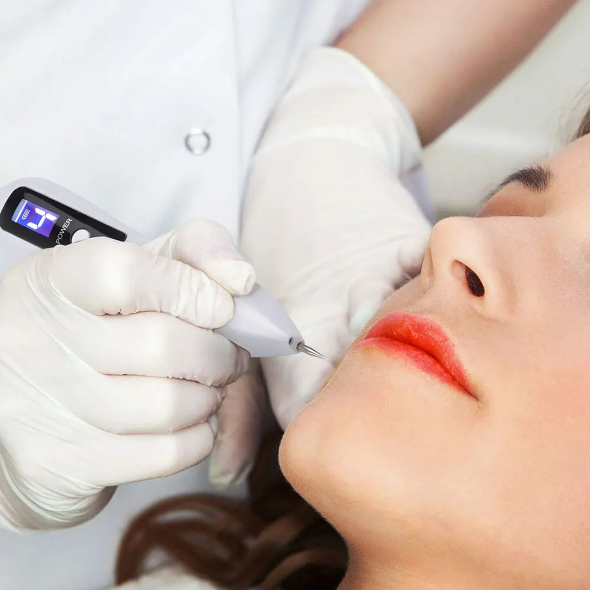 LCD Plasma Laser Pen – Portable Remover for Skin Tags, Freckles, Melasma & Tattoos