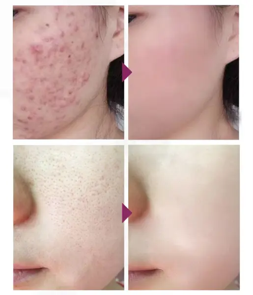 Acne Treatment Face Cream Blackhead Repair Gel Oil Control Shrink Pores Scar Whitening Moisturizer4