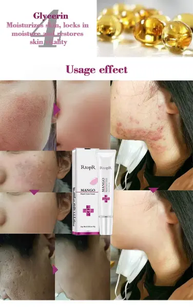 Acne Treatment Face Cream Blackhead Repair Gel Oil Control Shrink Pores Scar Whitening Moisturizer5