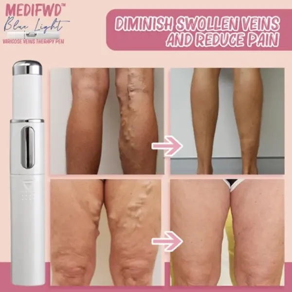 Medifwd Blue Light Therapy Varicose Veins Pen2