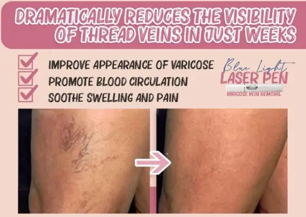 Spider Veins Removal Pen3