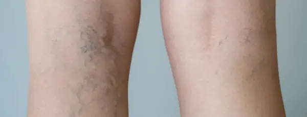 Varicose Veins Removal Cream7