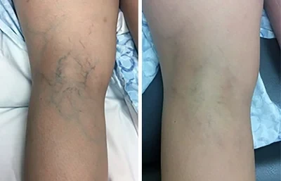 Spider Veins Removal Pen photo review