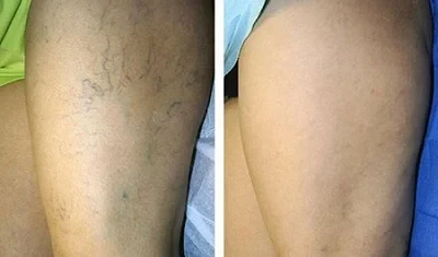 Spider Veins Removal Pen photo review